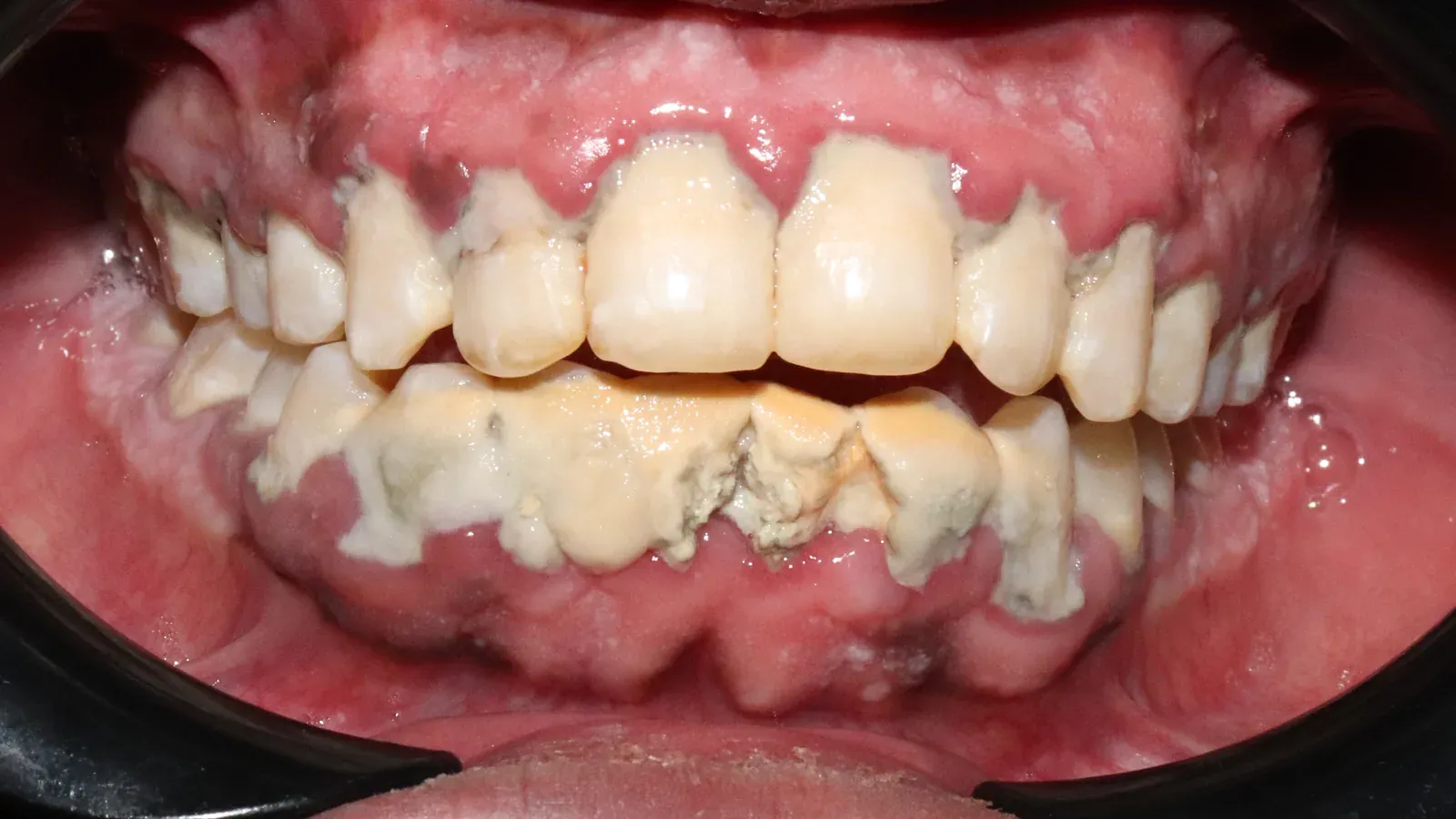Caso 01, limpieza dental profesional, antes: sarro y manchas acumulados sobre los dientes y el borde de la encía.