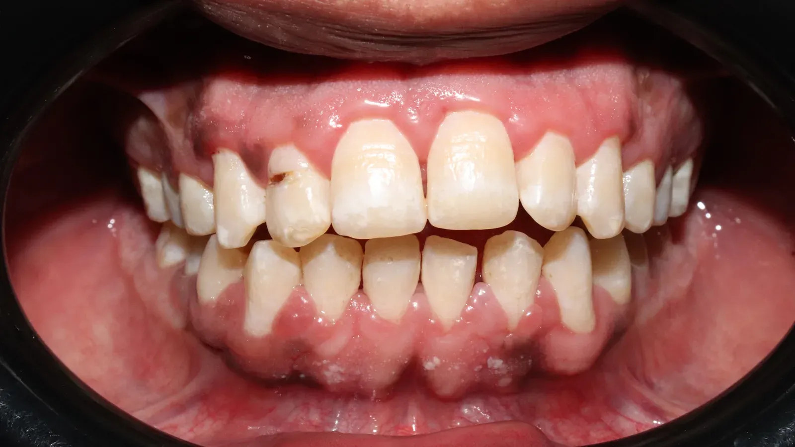 Caso 01, limpieza dental profesional, después: superficies limpias tras la limpieza profesional.