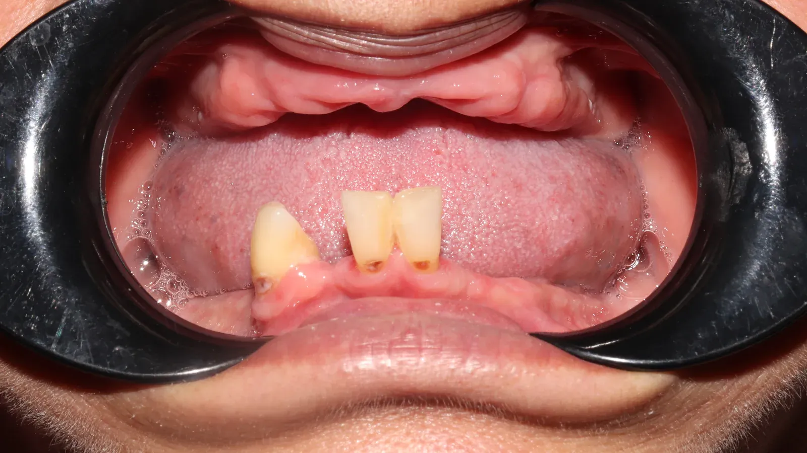 Caso 03, prótesis removibles superior e inferior, antes: arcada superior sin dientes y pocos dientes en la inferior.