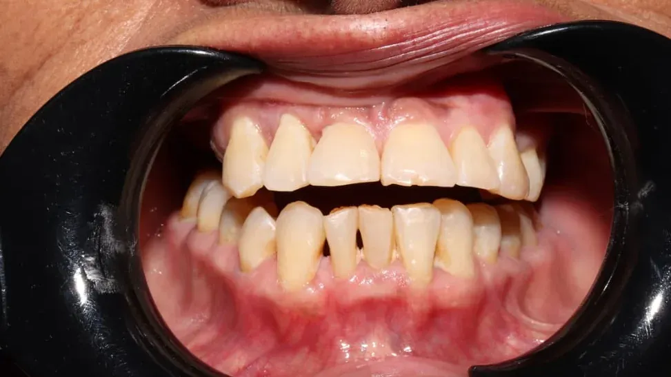 Caso 04, ortodoncia con brackets, antes: dientes desalineados y apiñados.