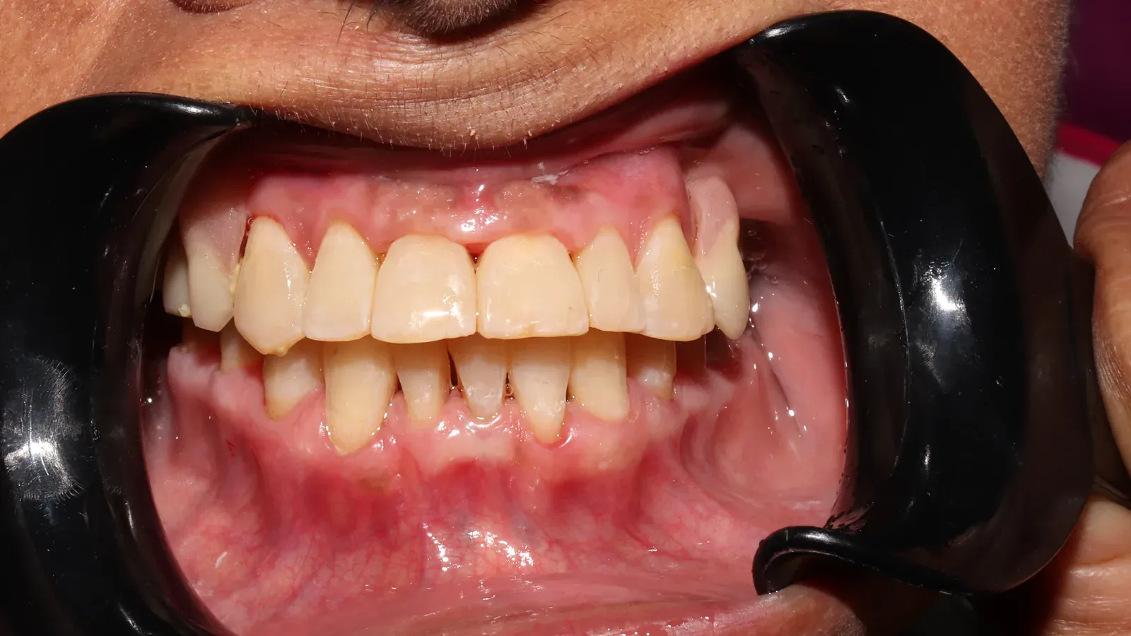Caso 04, ortodoncia con brackets, después: dientes alineados al terminar la ortodoncia.