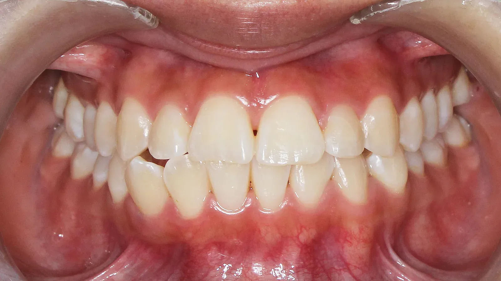 Caso 05, ortodoncia con brackets, antes: dientes apiñados y girados.