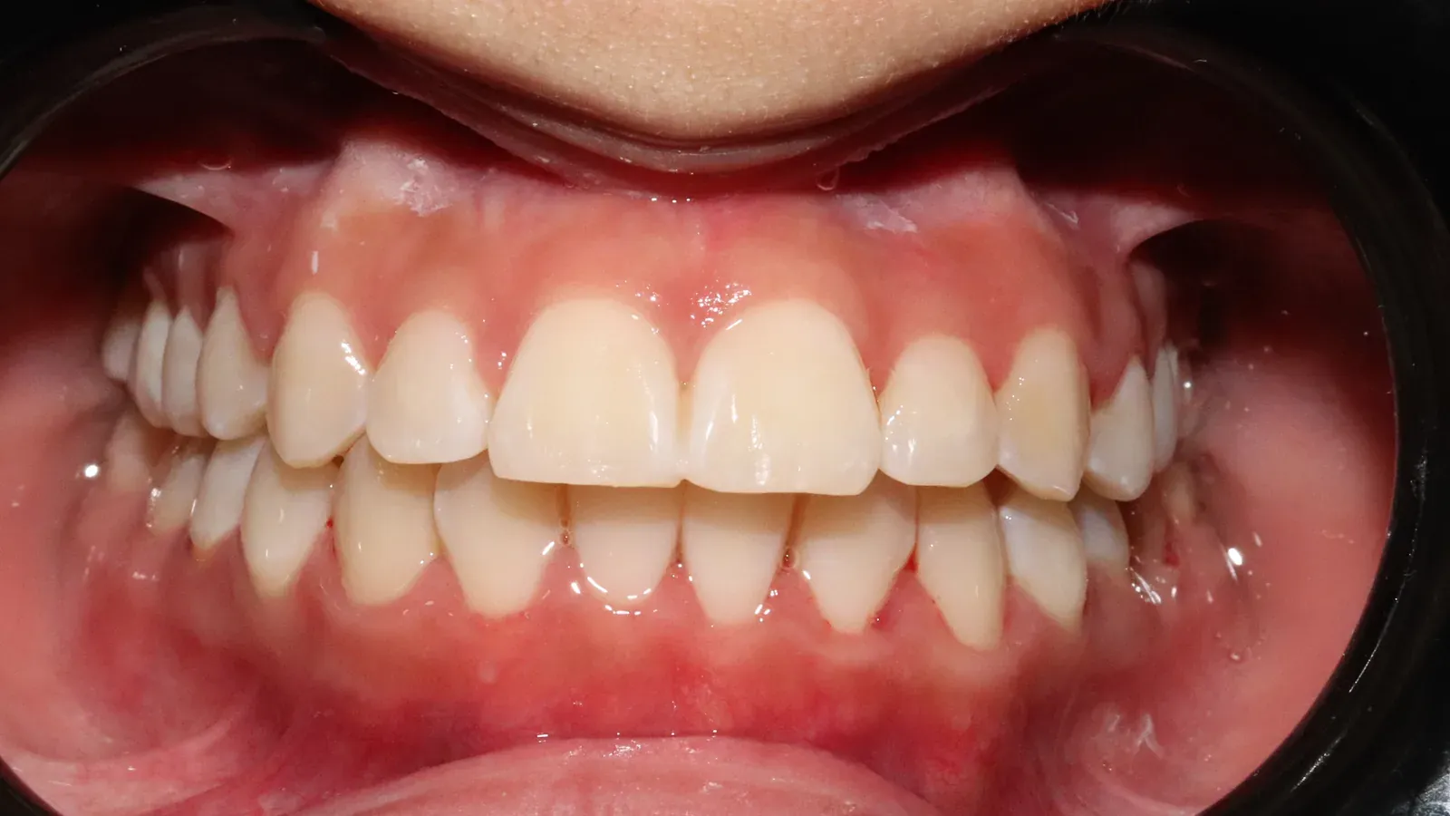 Caso 05, ortodoncia con brackets, después: arcadas alineadas al terminar la ortodoncia.