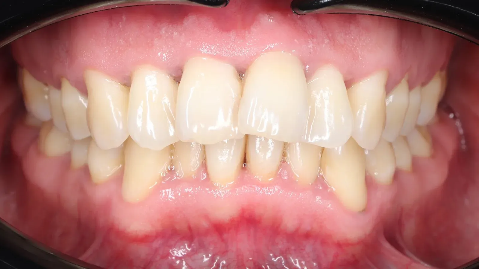 Caso 06, ortodoncia con brackets, antes: dientes apiñados y fuera de la línea de la arcada.