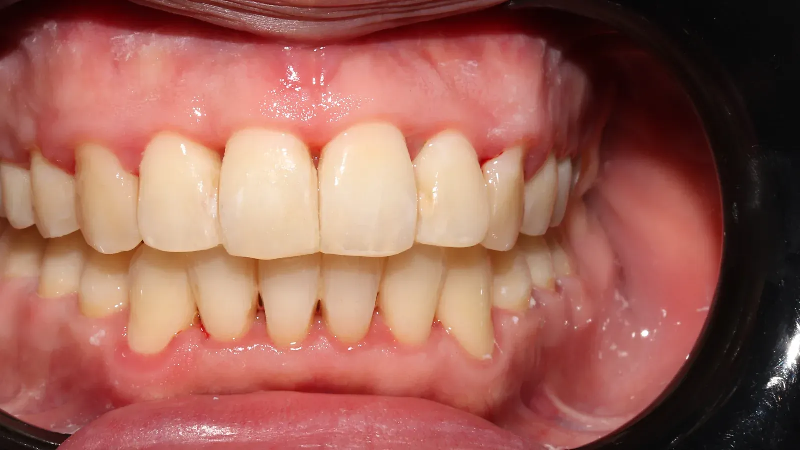 Caso 06, ortodoncia con brackets, después: dientes alineados al terminar la ortodoncia.