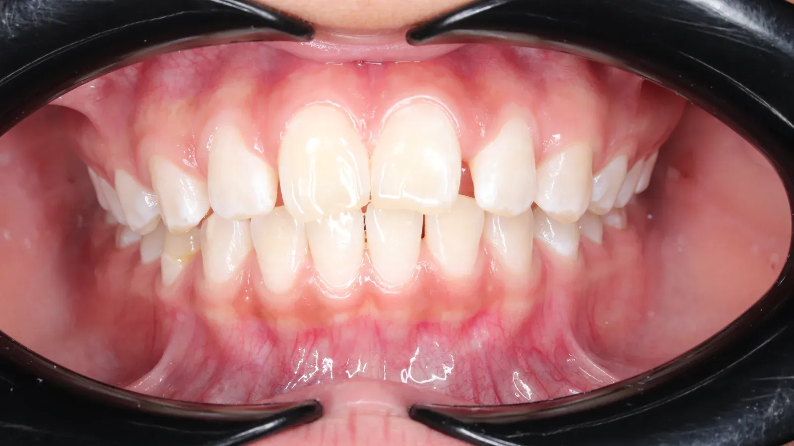 Caso 07, ortodoncia con brackets, antes: espacios entre los dientes.