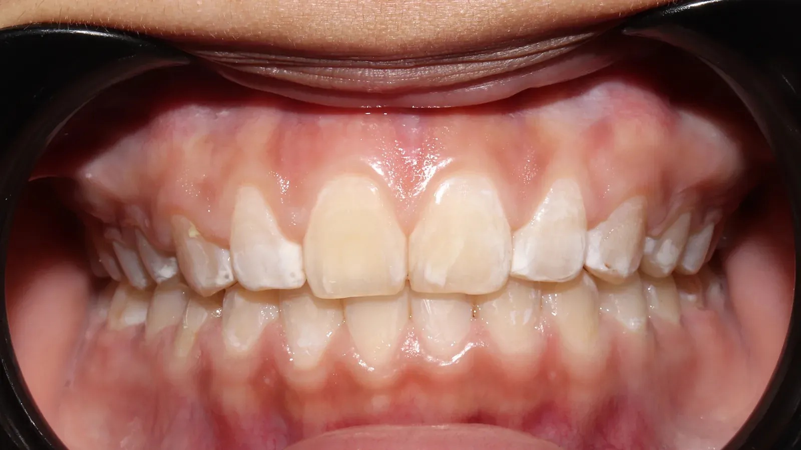 Caso 07, ortodoncia con brackets, después: espacios cerrados y dientes alineados.