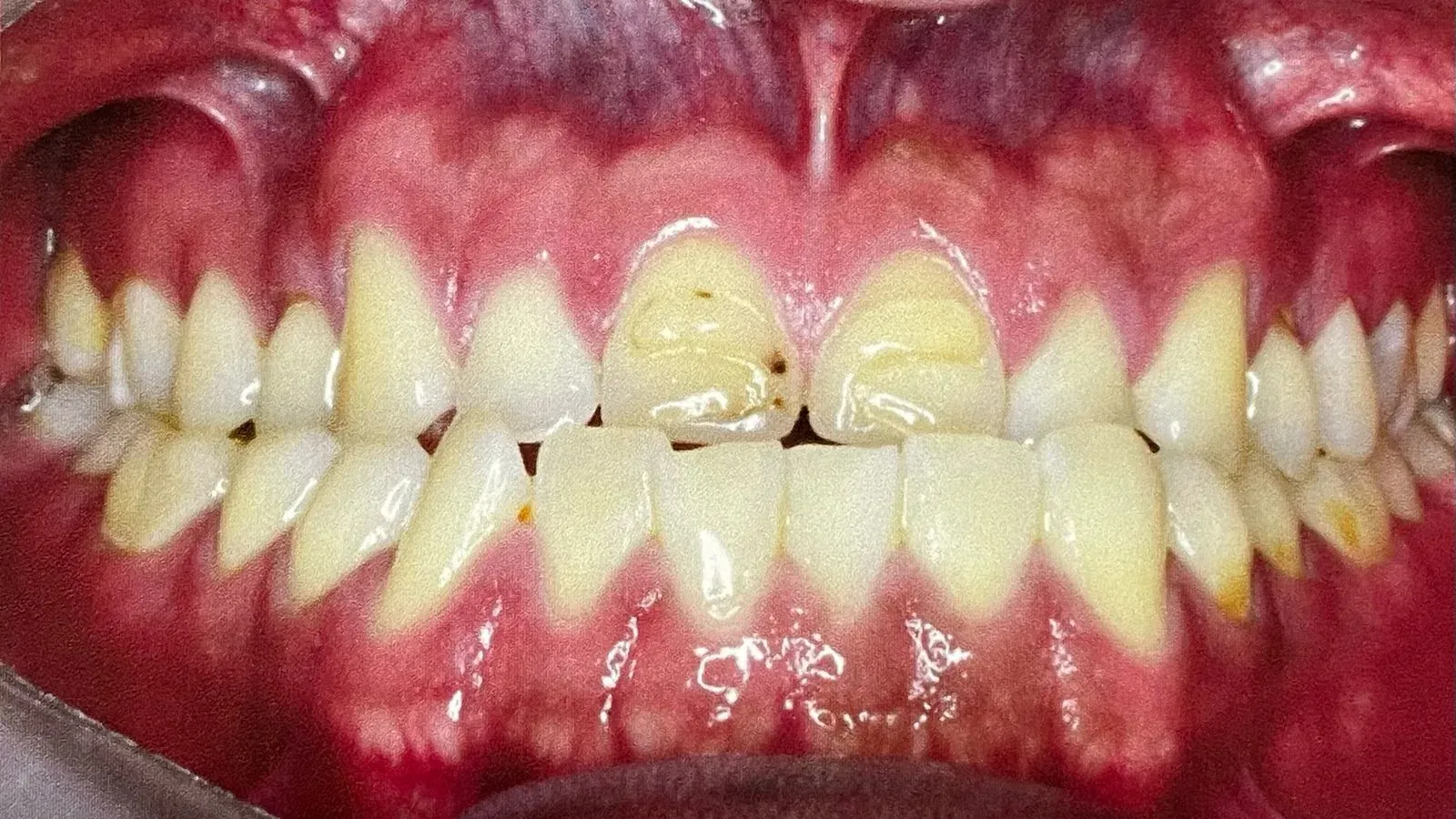 Caso 08, ortodoncia con brackets, antes: dientes desalineados y con separaciones.
