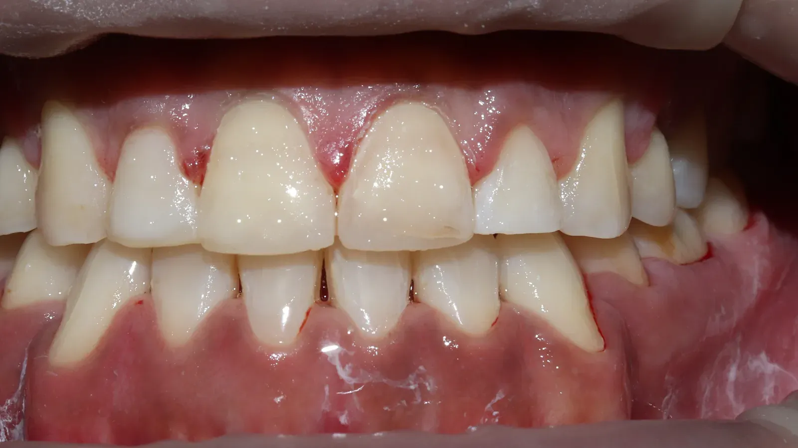 Caso 08, ortodoncia con brackets, después: dientes alineados al terminar el tratamiento.